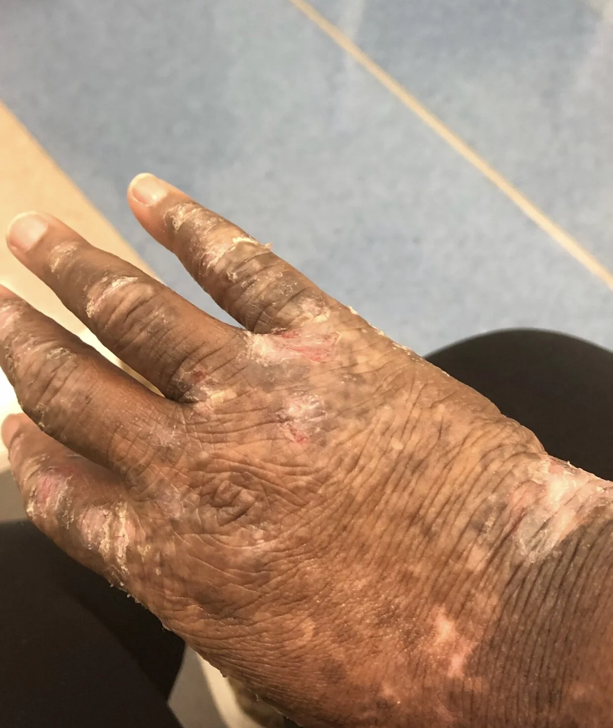 Exposing Eczema: Part I