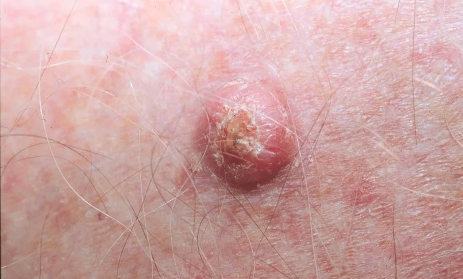 squamous2.jpg