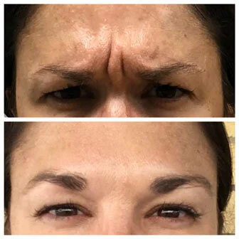 Neurotoxins In Pasadena, Ca - Skinfx Medical Spa for Beginners thumbnail