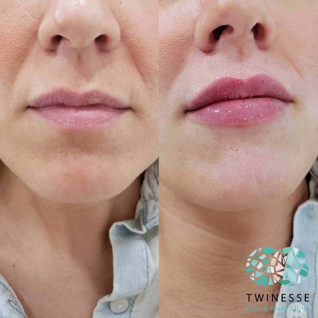 Lip Filler Oakville