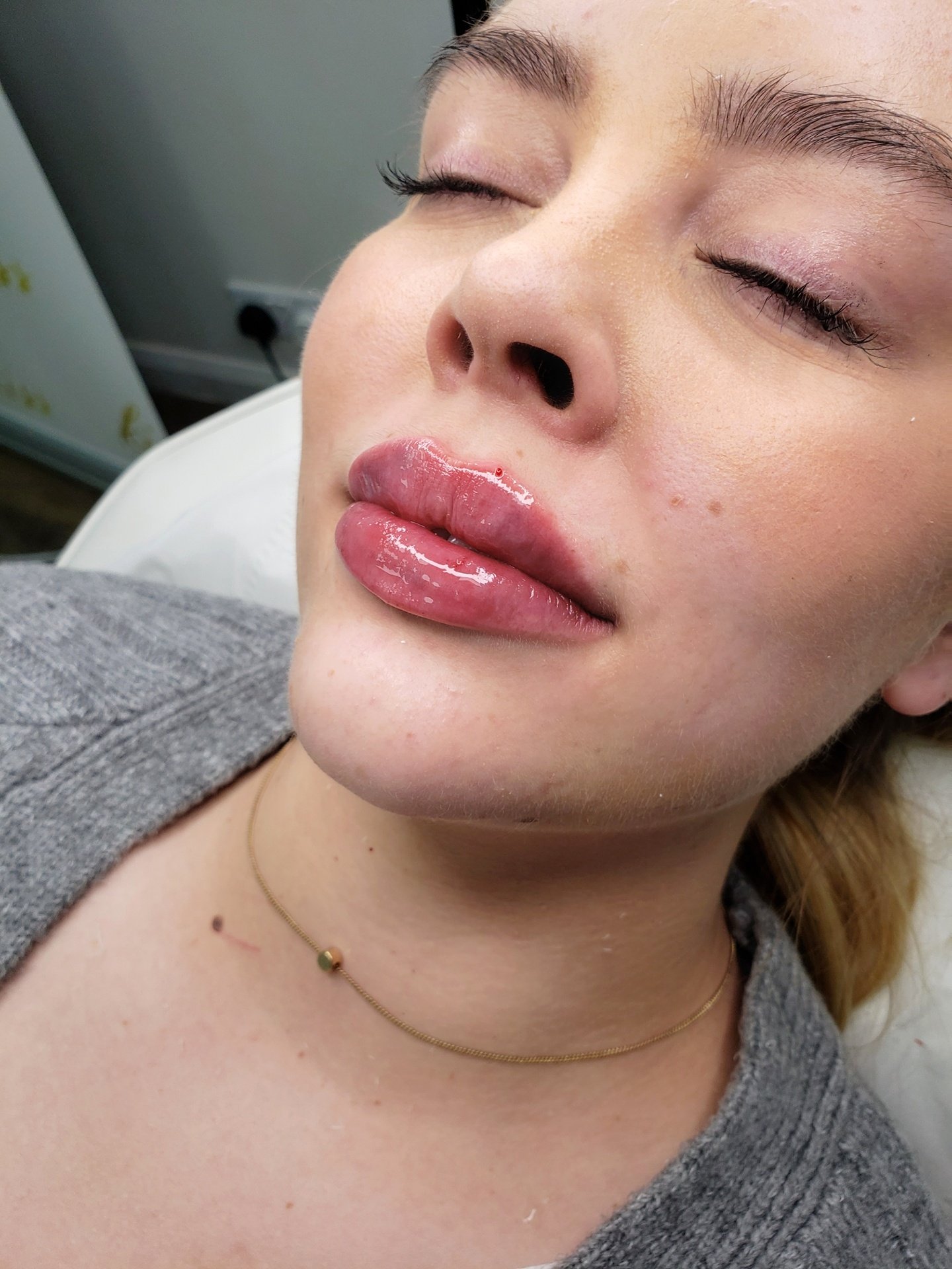 Russian Lip Filler Toronto