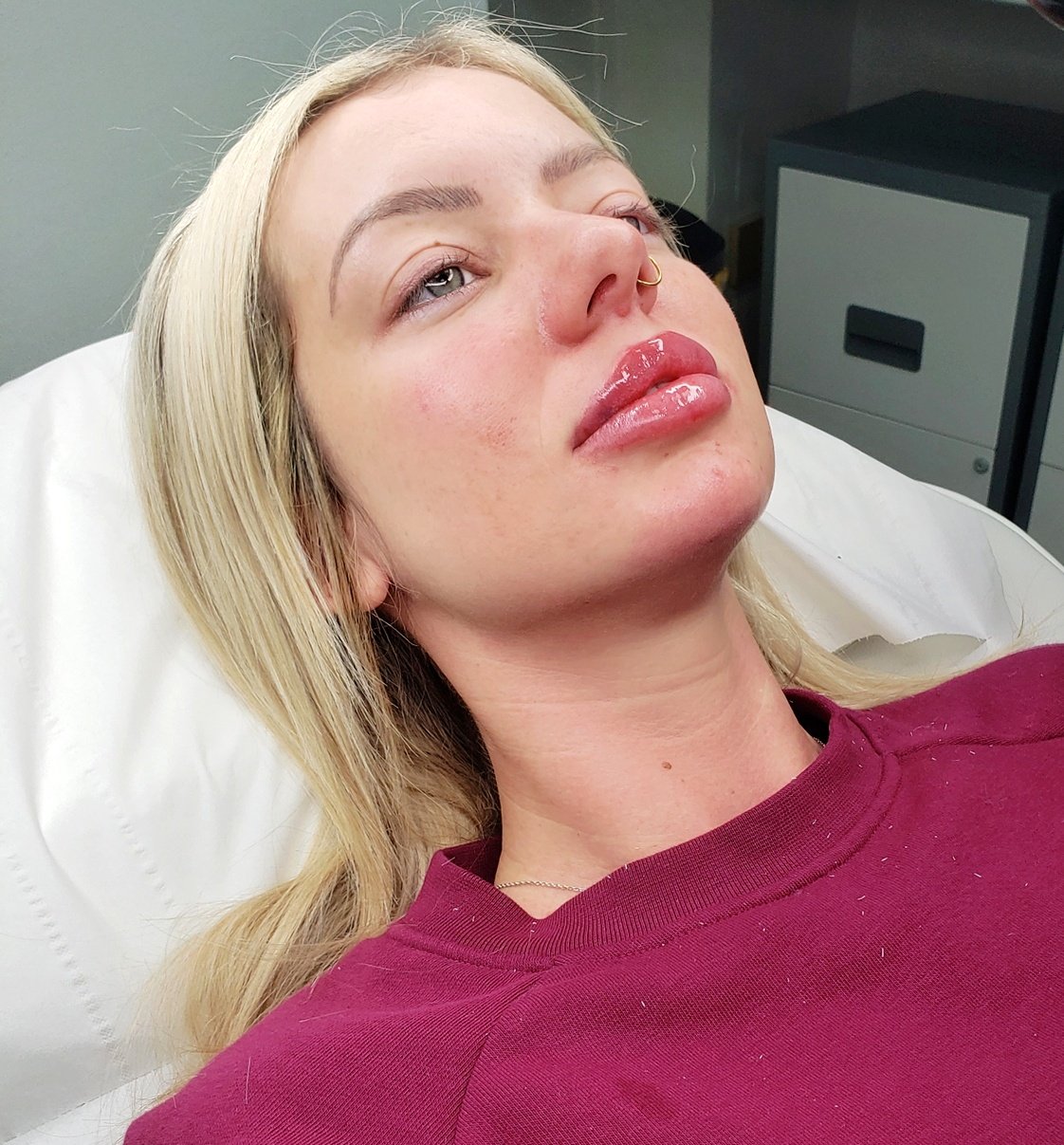 Russian Lip Filler Toronto