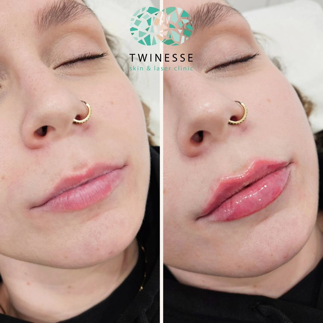 Soft and Subtle 💋 

Who says lip fillers can't look natural? 

The goal was to plump the lips and define the cupids bow, while maintaining the client&rsquo;s natural lip shape. 

💉 Technique used was a combination of Russian lip technique and linea