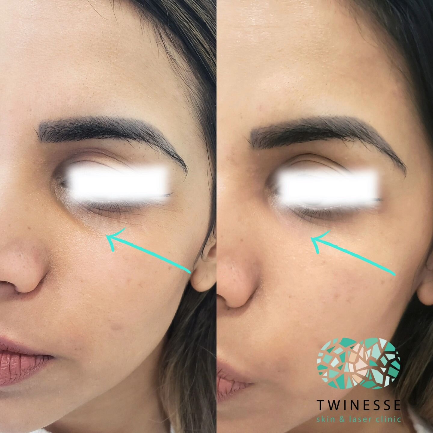 Are you tired of looking tired?! 👀 💉

Hollowness causes the eyes to look tired and aged, and is one of the most common complaints we get from clients. 

The most popular treatment is a tear trough filler. A very soft filler is carefully used to fil