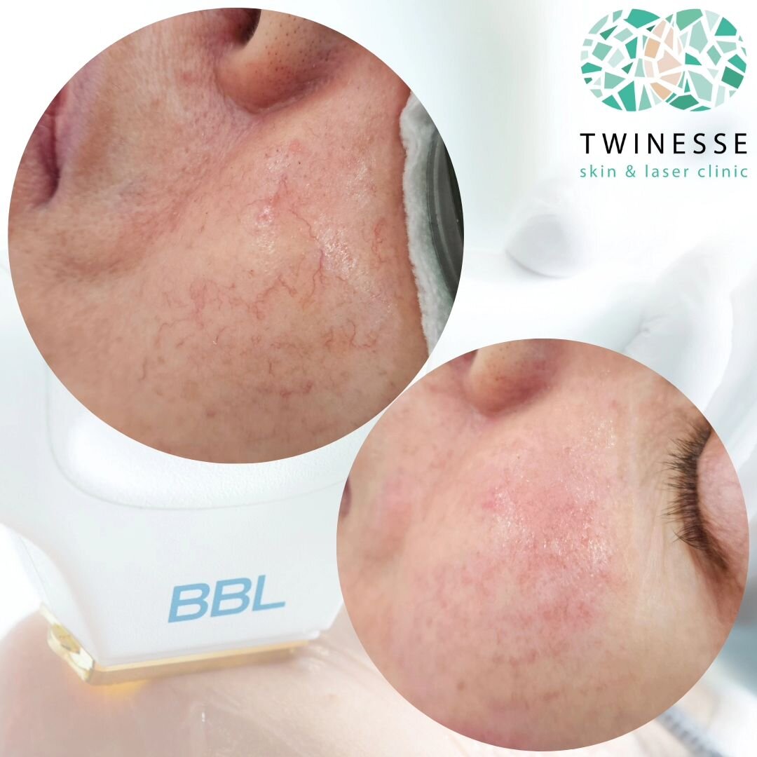 Blood vessels be gone! 🪄✨️ 

BBL Laser targets and eliminates vessels and broken capillaries with as little as one session! 

Broken blood vessels on the face can occur just beneath the surface of the skin.&nbsp;Genetics, sun exposure, changes in bl
