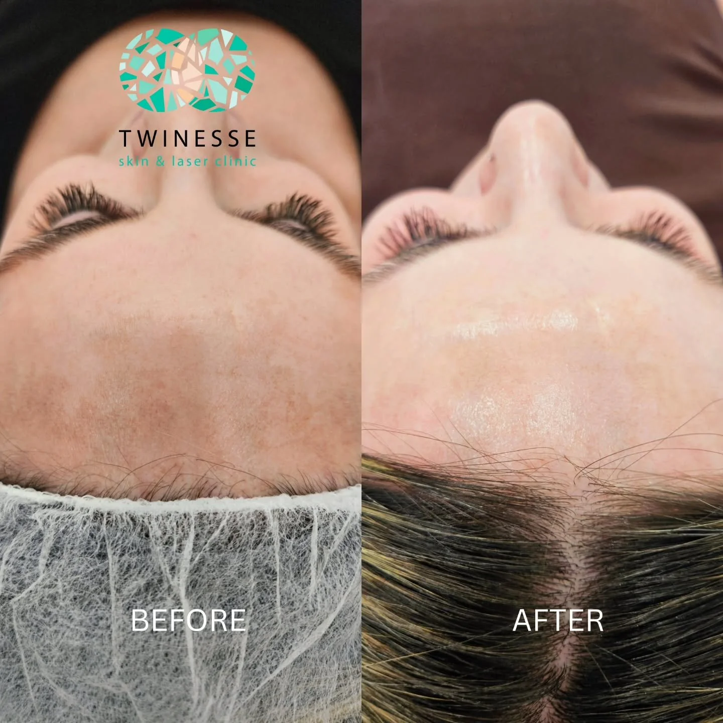 The HALO GLOW is real ✨️ 

Transformational results after 1 combo treatment of Halo &amp; BBL Laser! Years of stubborn melasma and sun damage removed with 1 treatment! 🙌🏼🤩

📸 2 weeks after treatment 

Call or email to start your glow journey toda