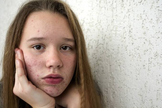 Teenagers & Acne // the living nightmare