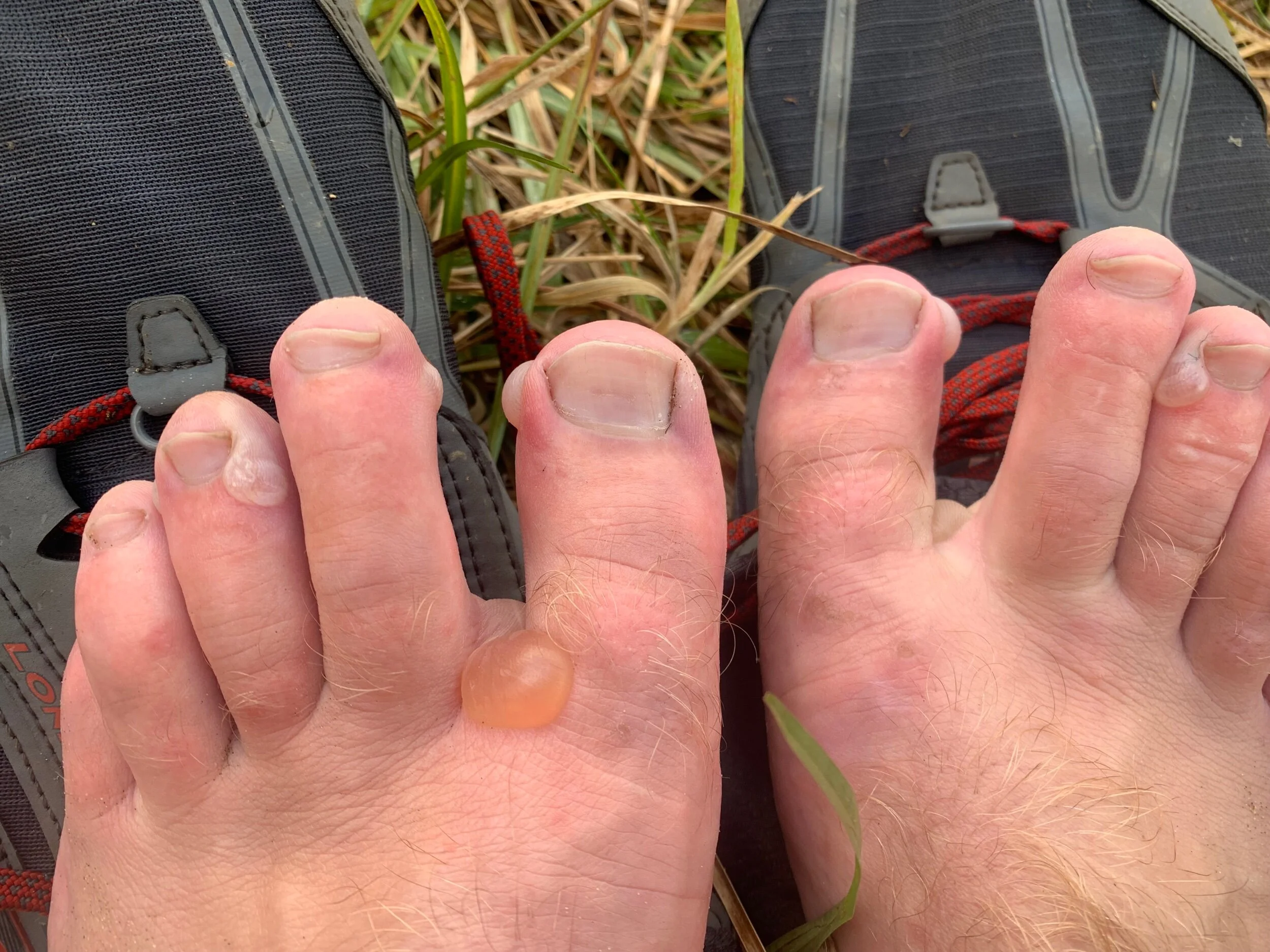 Blisters on Alex’s feet