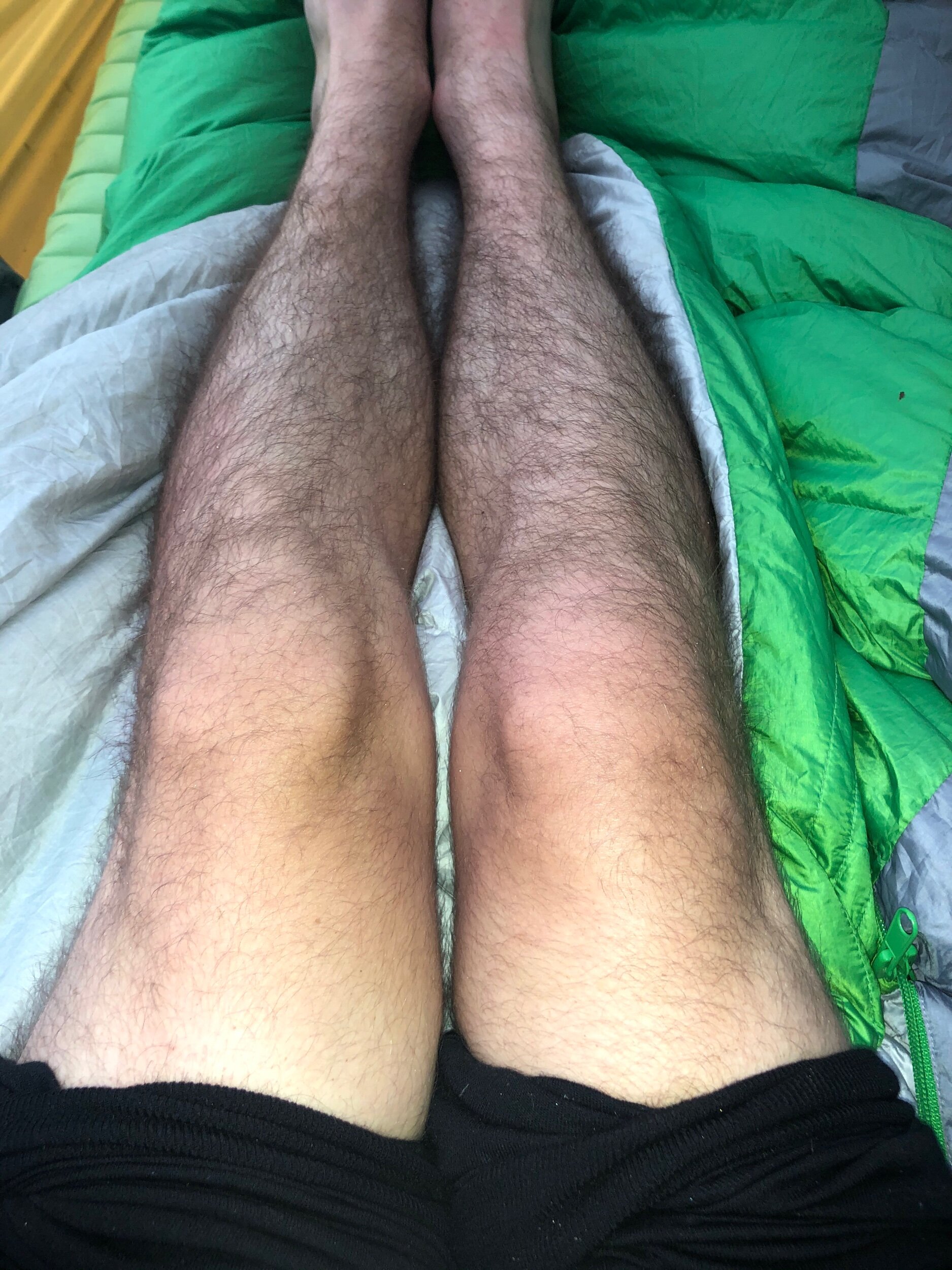 Swollen right knee