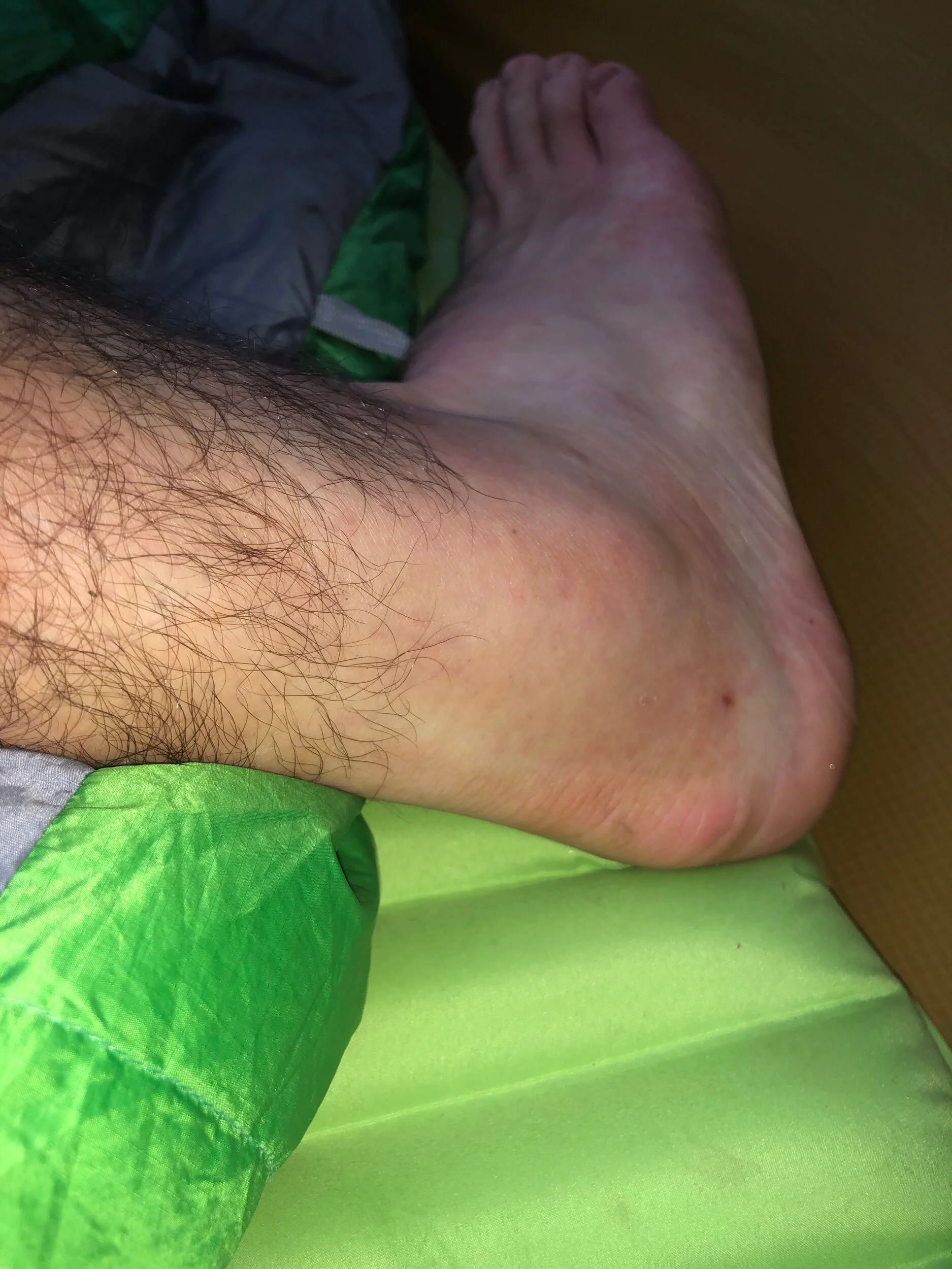 Swollen right ankle