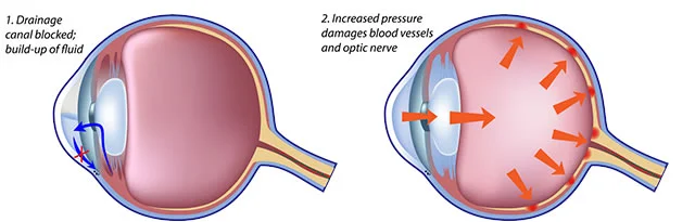 glaucoma.jpg