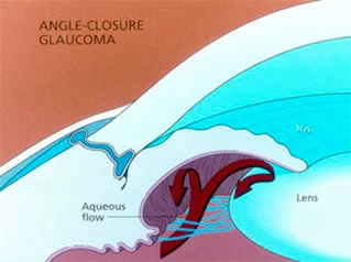 angle-closure-glaucoma.jpg