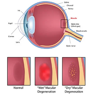 Macular degeneration
