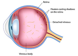 Floaters &amp; Flashes