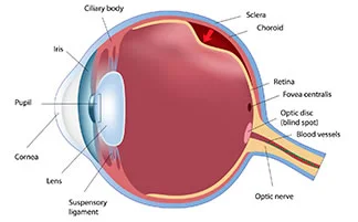 Retinal Detachment
