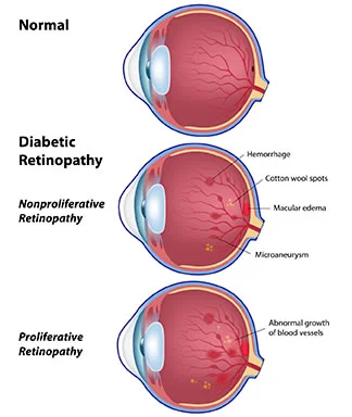 diabetic-retinopathy.jpg