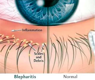 blepharitis.jpg