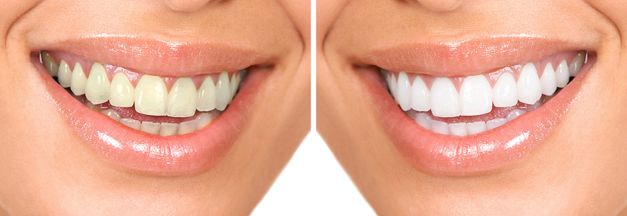 bigstock-Whitening-Dental-care-health-17662580.jpg