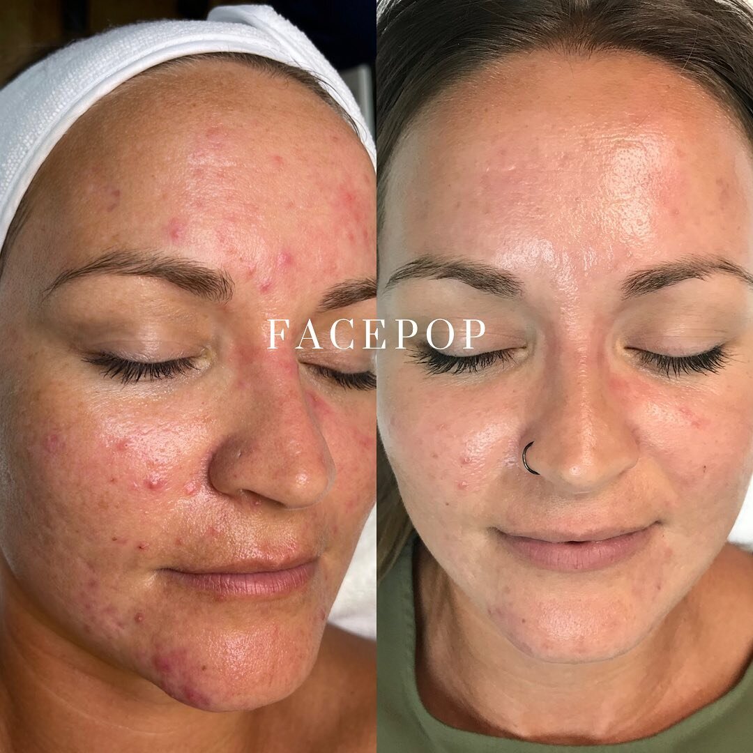 Face Reality for the win 🥇 look how her skin responded to the FR products and treatments within five weeks! 

✨Friendly reminder that everyone&rsquo;s skin is different and may respond quicker or take 4-6+ months ✨
No matter how long it takes we got