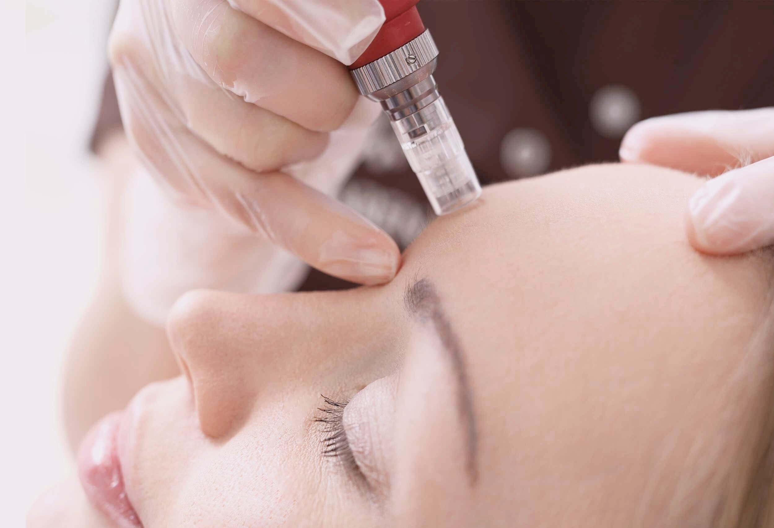 Microneedling-on-skin5-Gloss-Beauty.jpg
