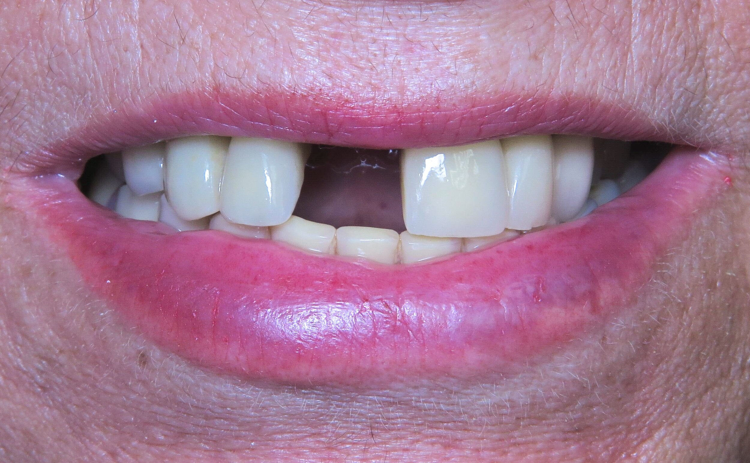 Dr. Tony Bae Coastal City Dental Implant - MB Before.jpg