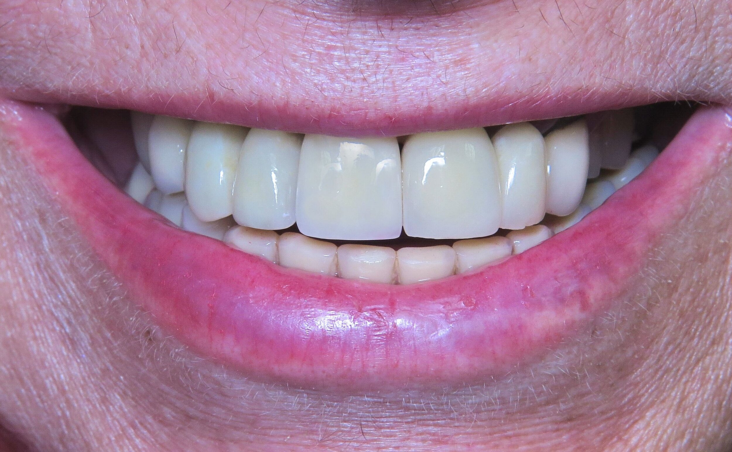 Dr. Tony Bae Coastal City Dental Implant - MB After.jpg