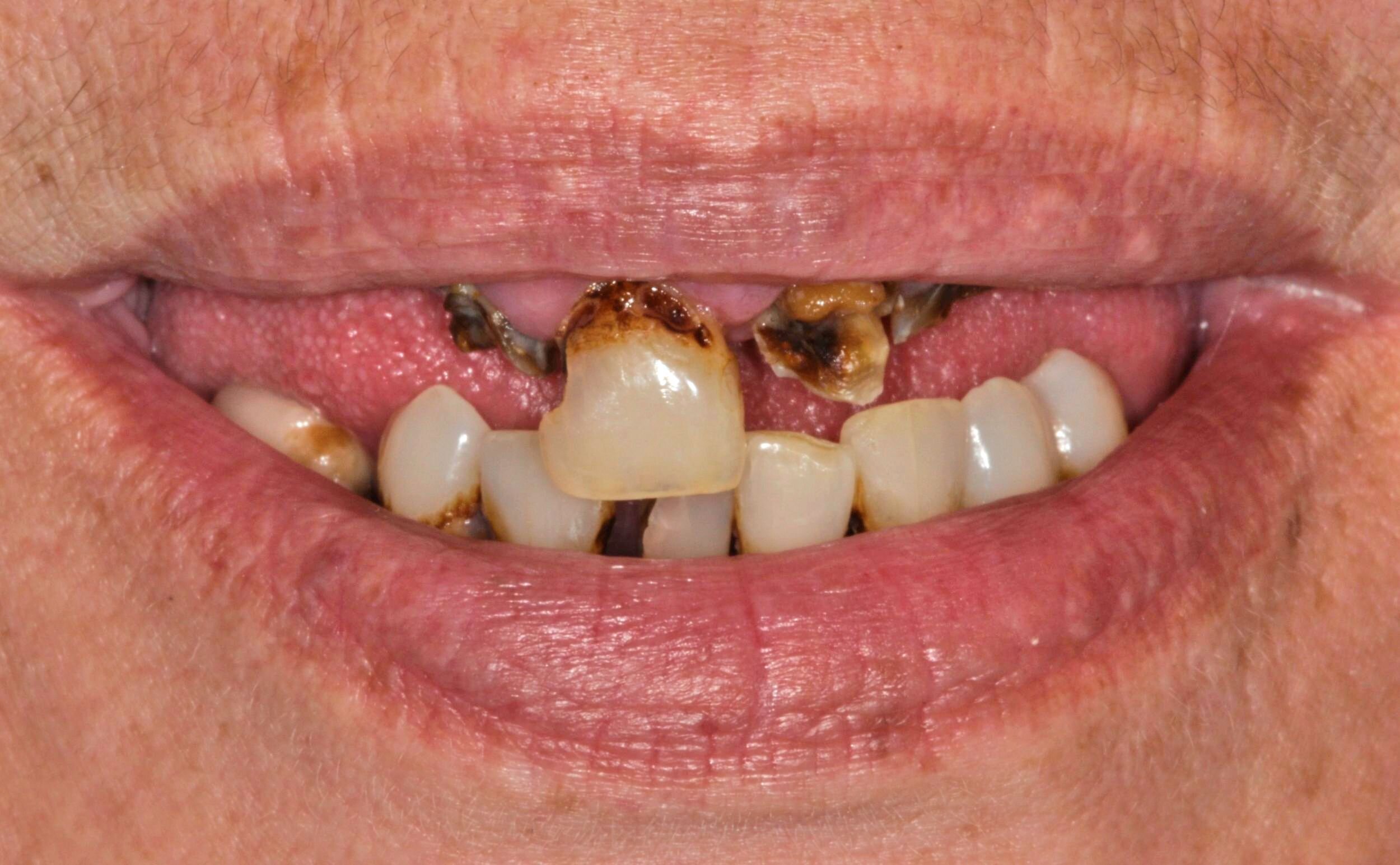 Dr. Tony Bae Coastal City Dental Implant Denture - BW Before.jpg