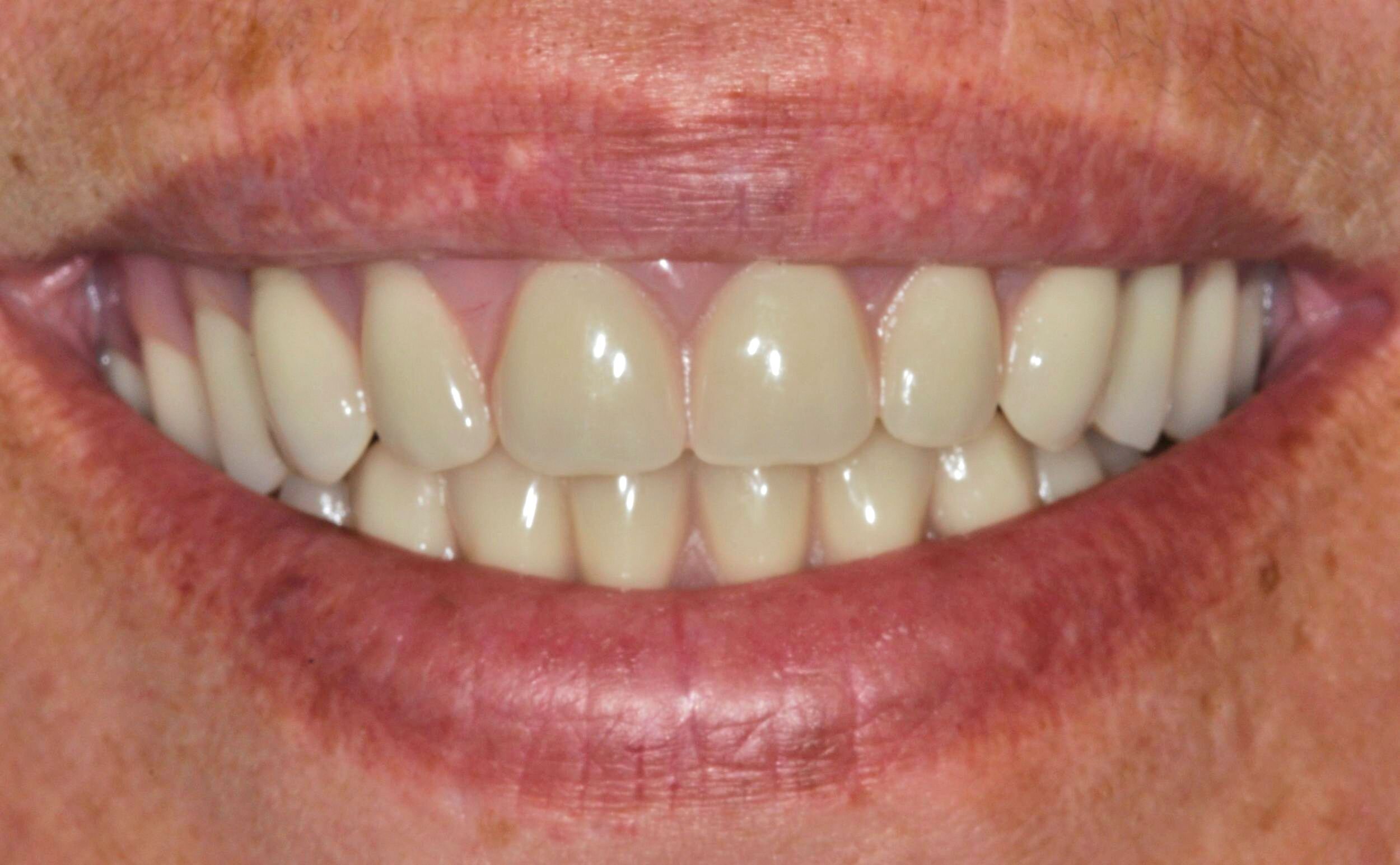 Dr. Tony Bae Coastal City Dental Implant Denture - BW After.jpg