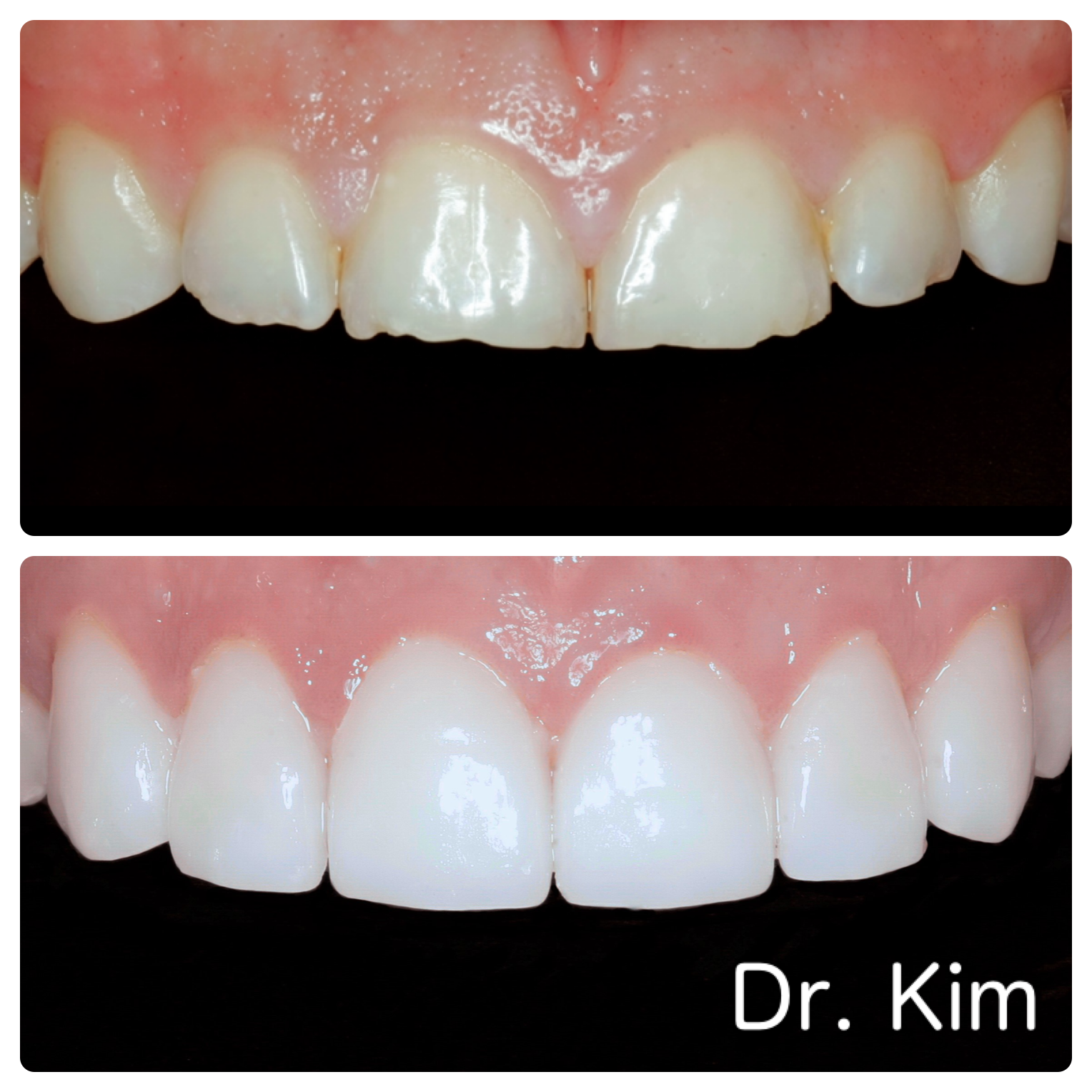 Porcelain crowns due to severe tooth wear