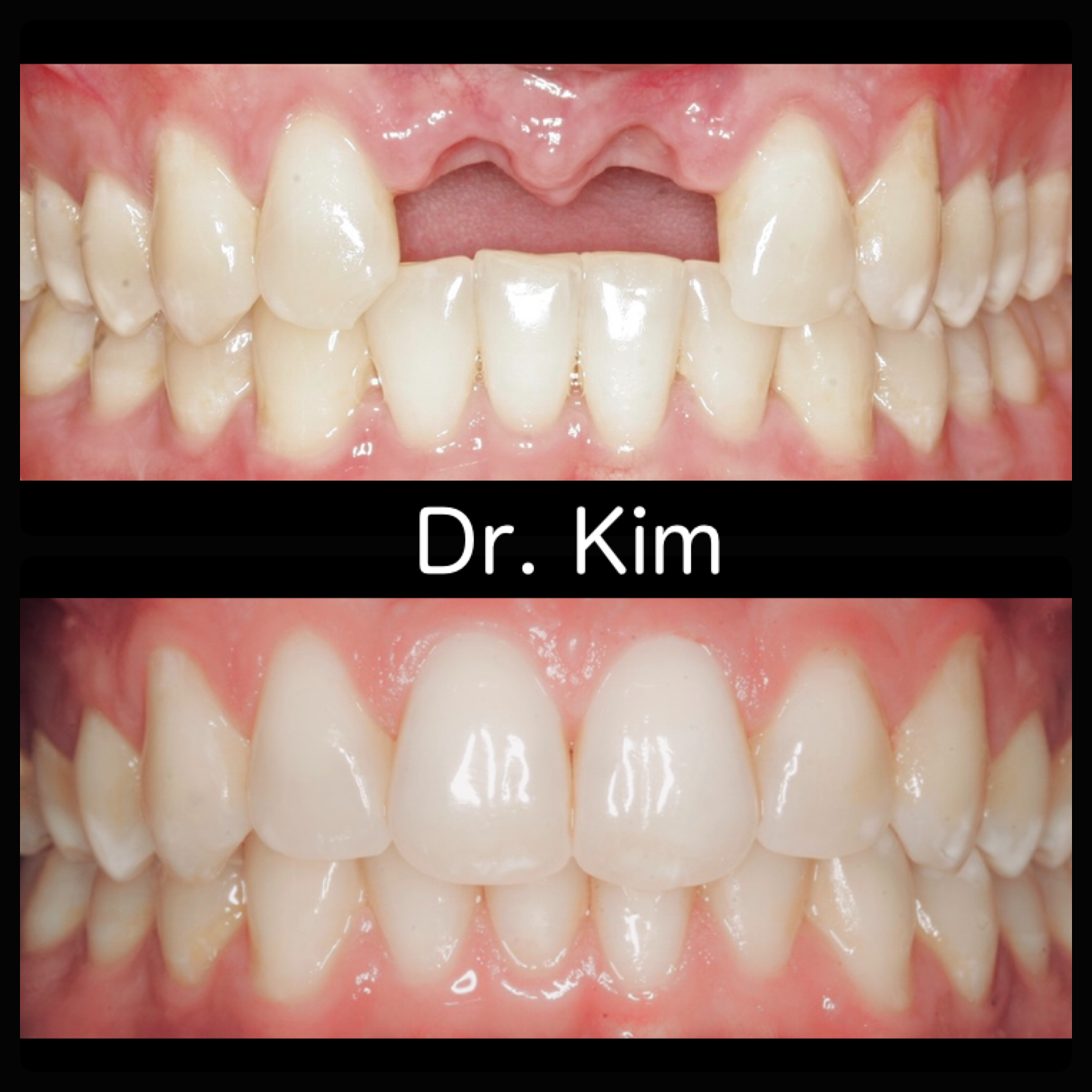 Two dental implants and crowns due to traumatic tooth loss