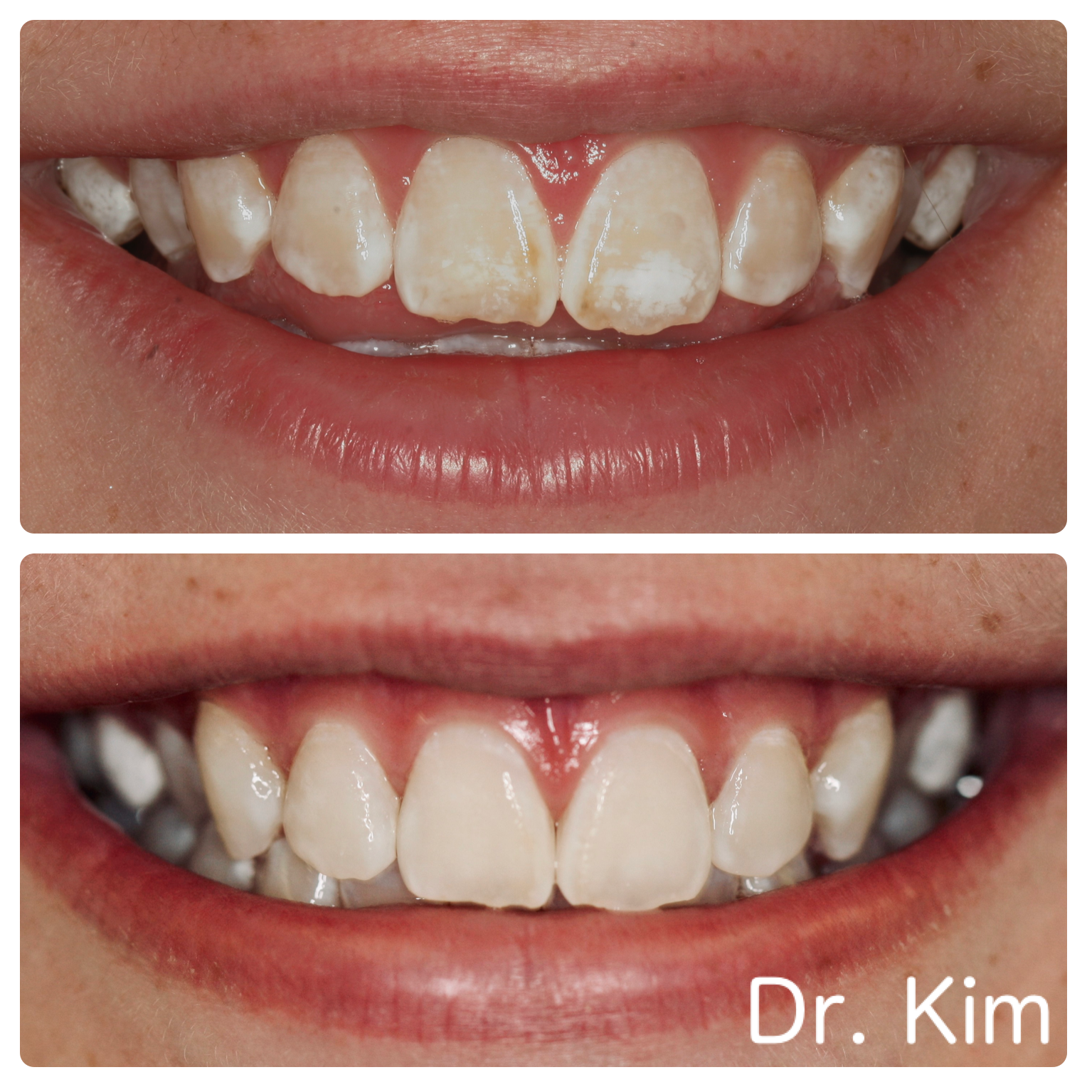 Removed white and brown spots without anesthetic or drilling