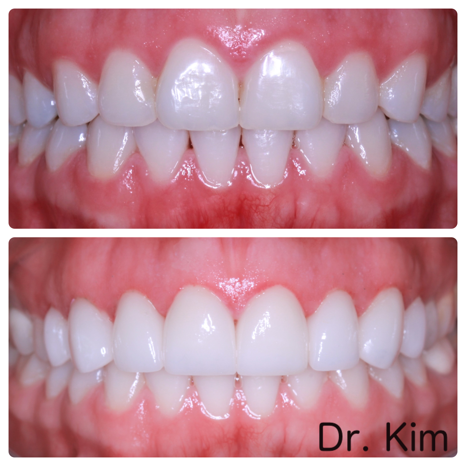 Minimally invasive veneers to create ideal tooth proportions