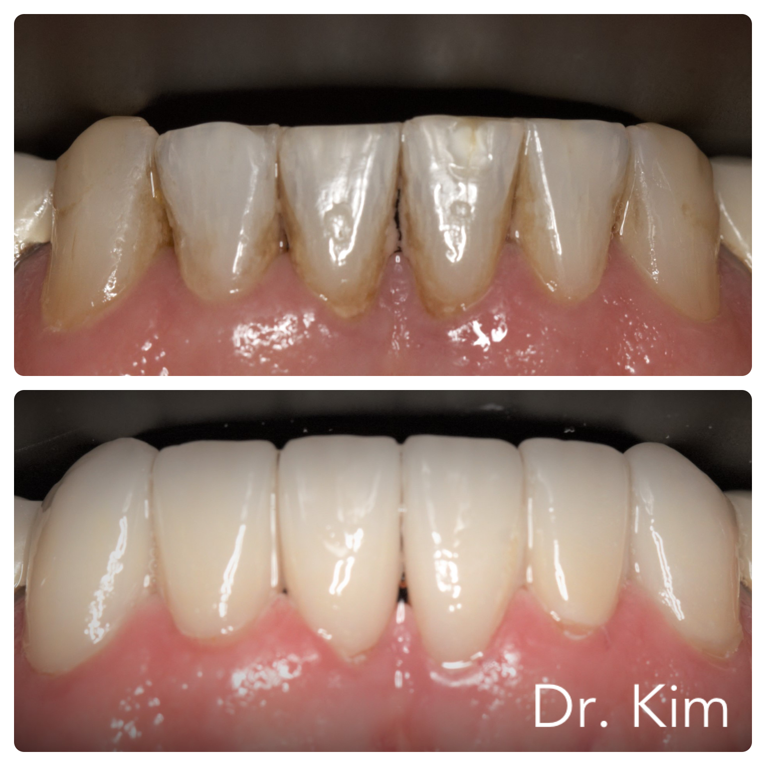 Combination of crowns and veneers to brighten tooth color and restore to ideal tooth proportions