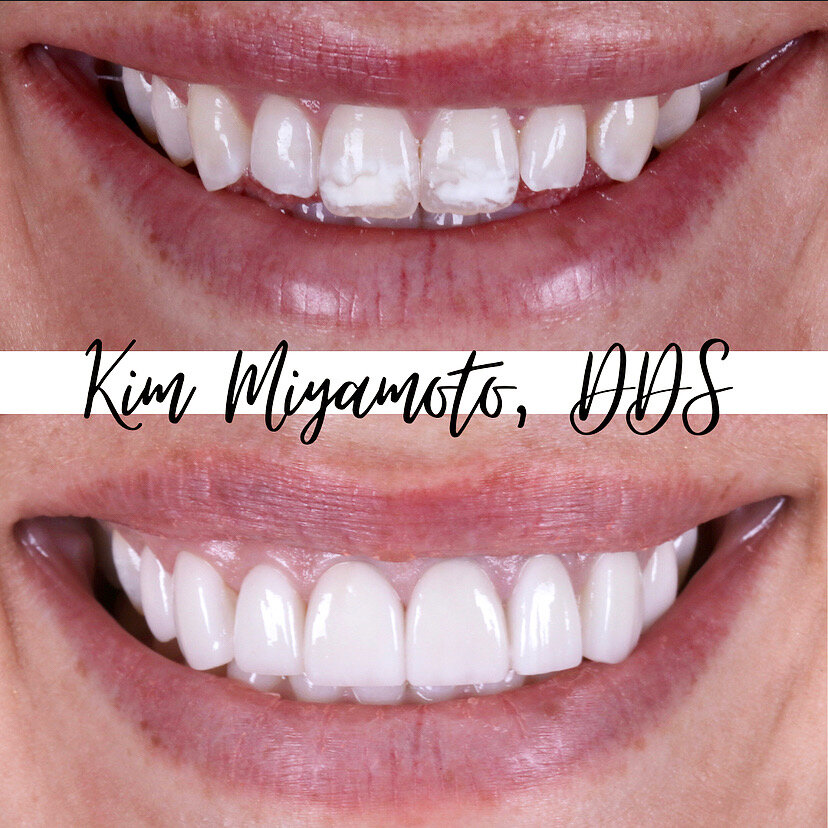 Porcelain veneers to correct color and shape