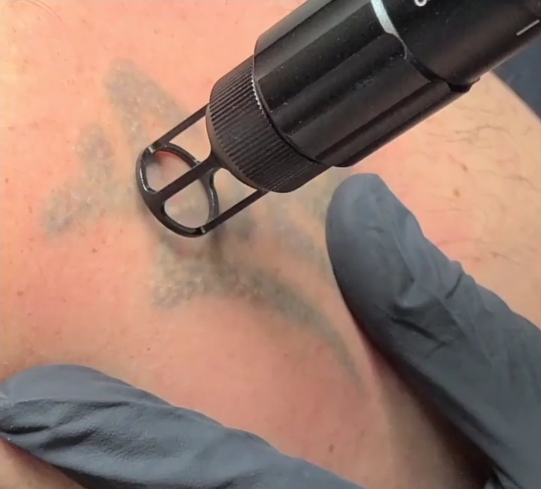About Us | Expert Tattoo Removalists | Tattoo Removal Institute