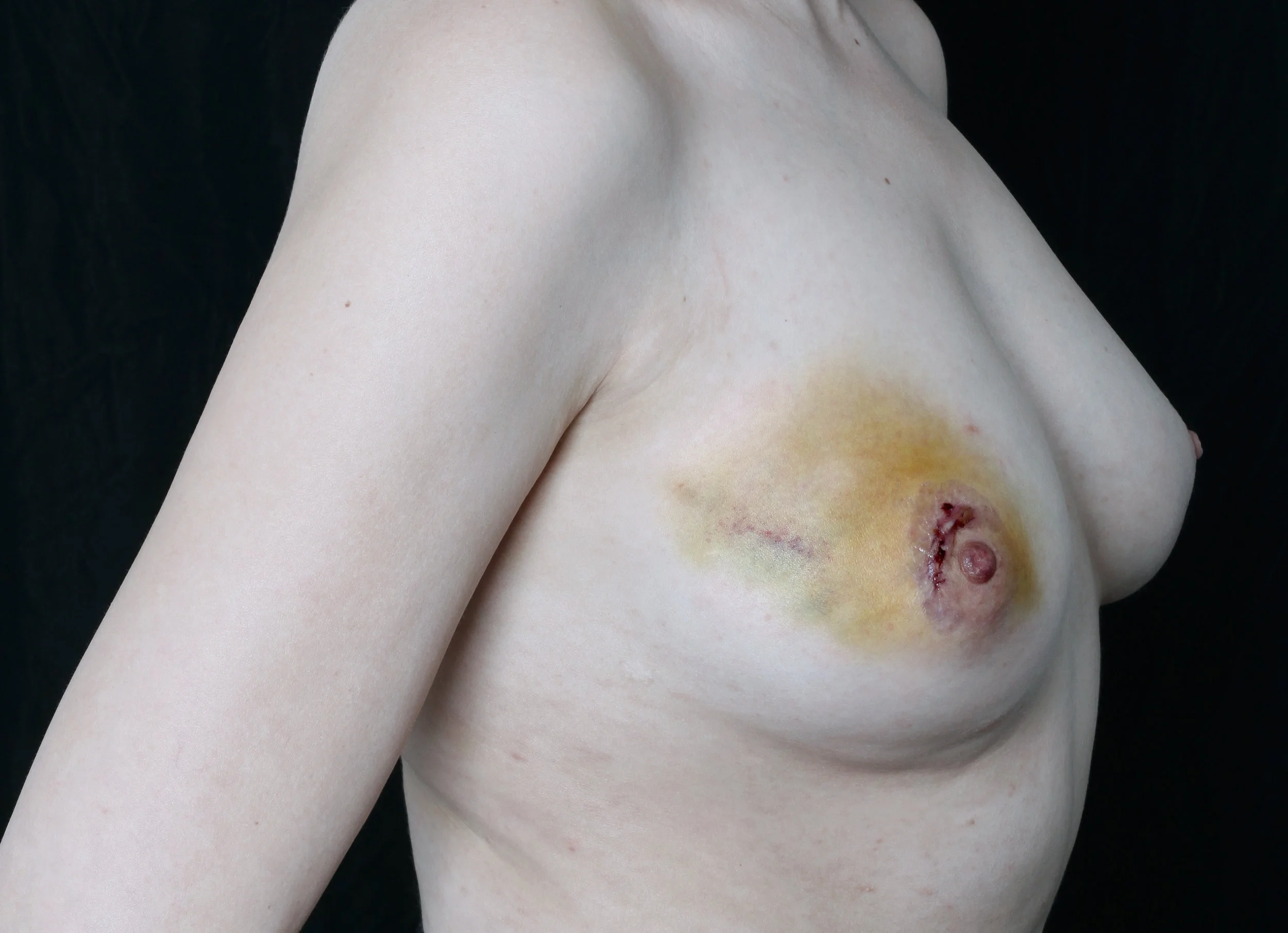 Recovery , 2017 A self-portrait taken one week after Mills’ second surgery to remove a benign fibroadenoma from her right breast.