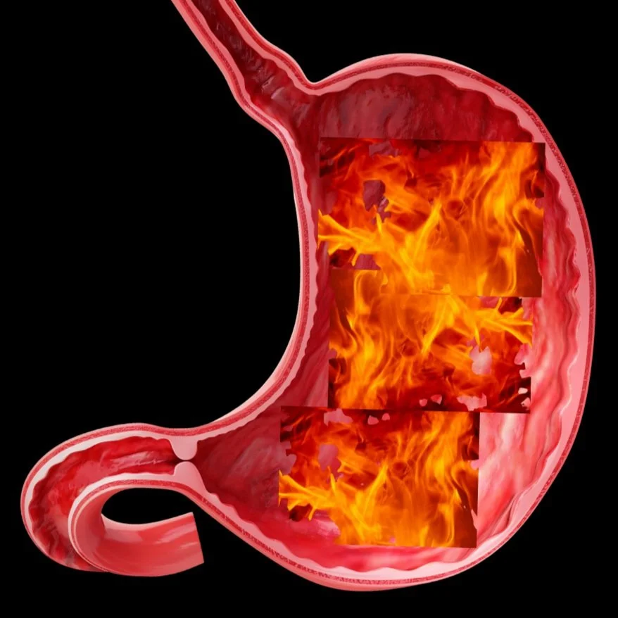 Gastroesophageal Reflux Disease Presents Differently in Women and Men
