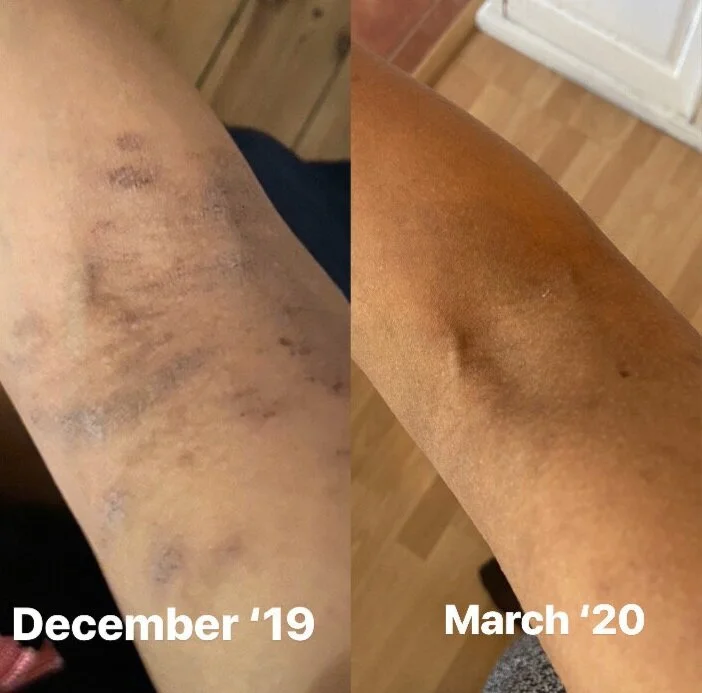 My eczema story: How I look after my skin &amp; my top tips for you