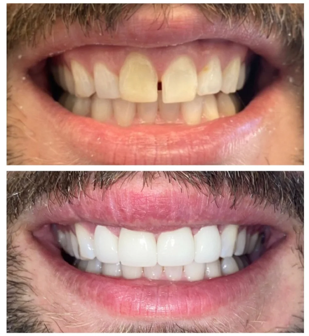 Can You Fix A Dogs Broken Tooth