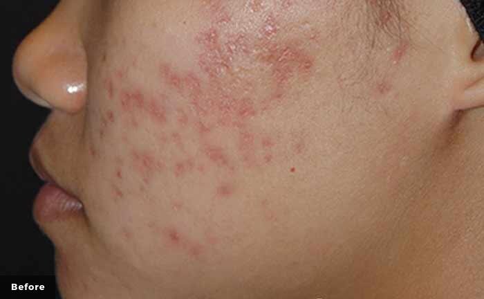 xeo-skin-resurfacing-acne-scars-lasergenesis-Tahl-Humes-MD-P1-before.jpg