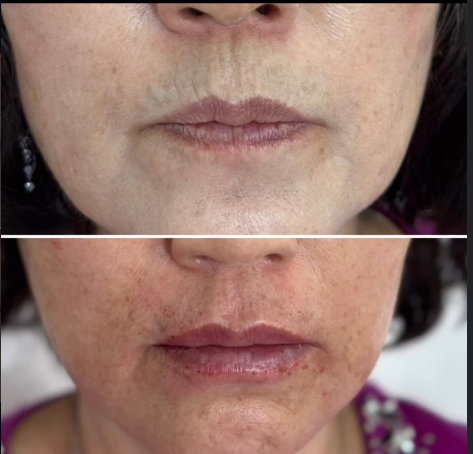 lip filler 2.PNG