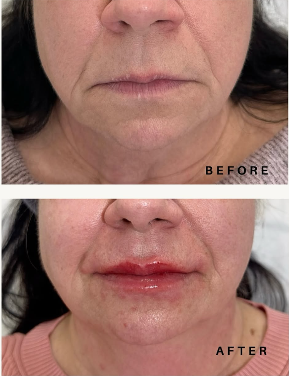 lip filler 1.PNG