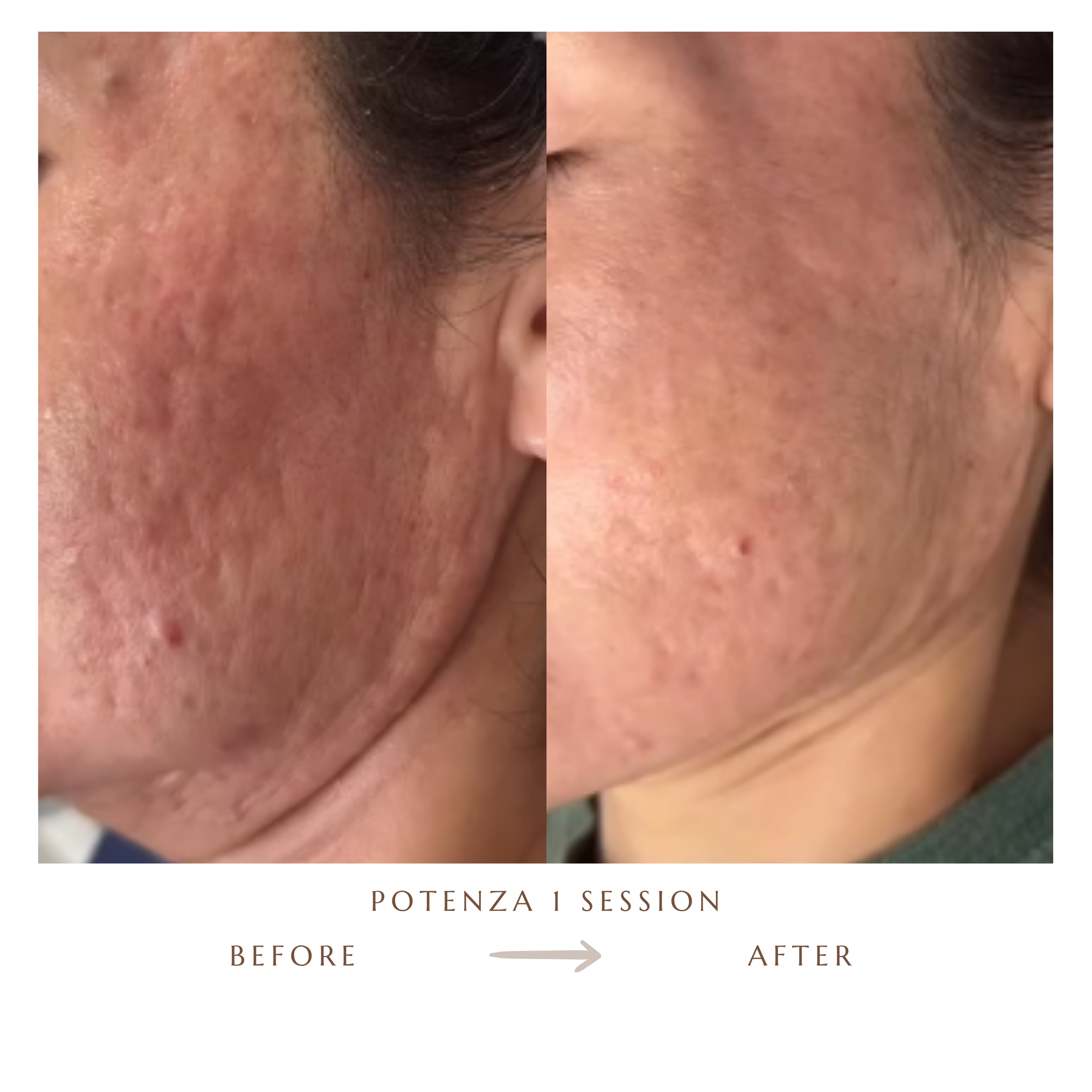 Before and after Potenza RF microneedling, 1 session, at JP Med Spa Raleigh NC