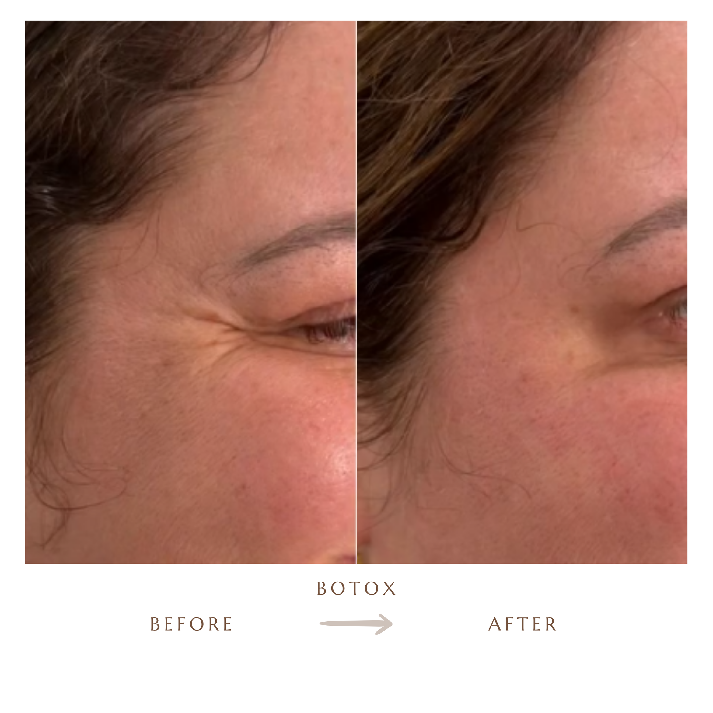 Before and after Botox for crow's feet at JP Med Spa Raleigh NC