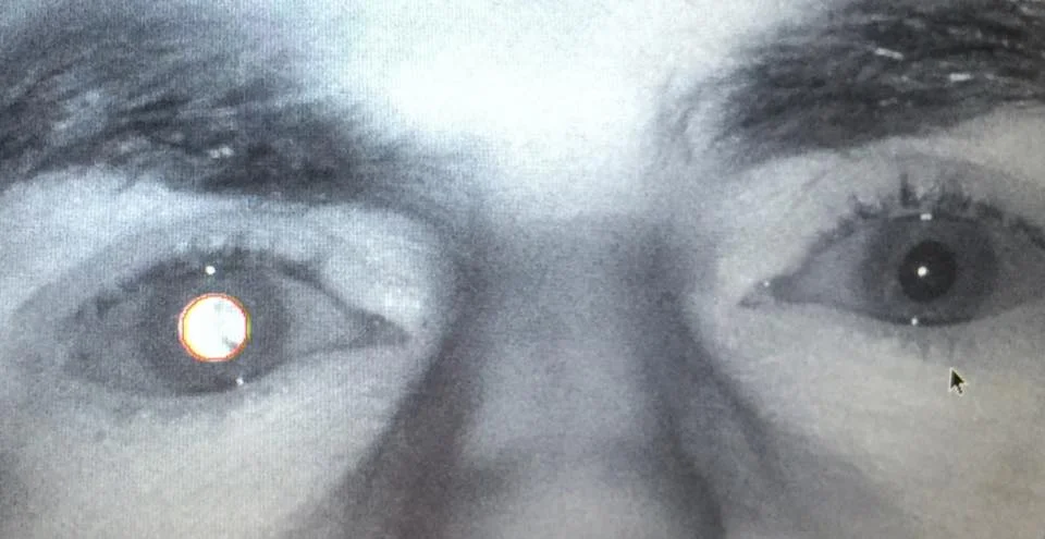 Cataracts adult and infantile