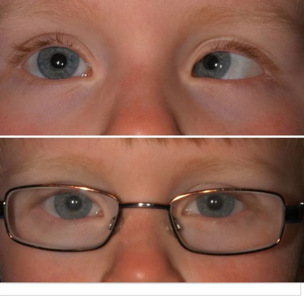 Accomodative esotropia