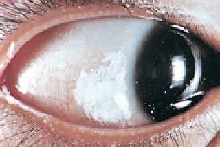 Fussy eaters could be faced with blindness – Vitamin A deficiency