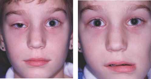 Marcus Gunn, or Jaw Winking Syndrome