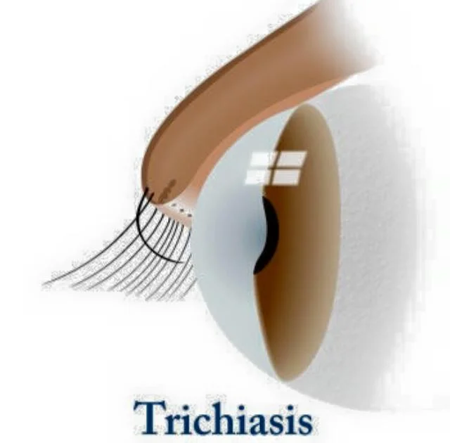 Trichiasis- the Ingrowing Eyelashes