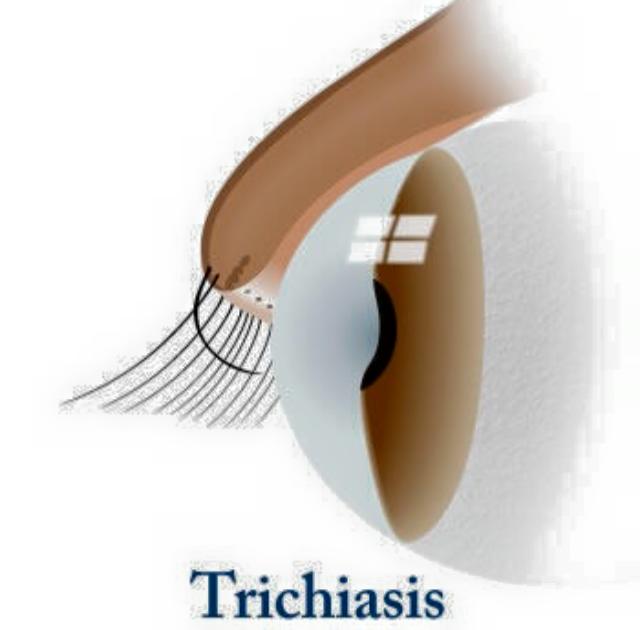 trichiasis.jpg